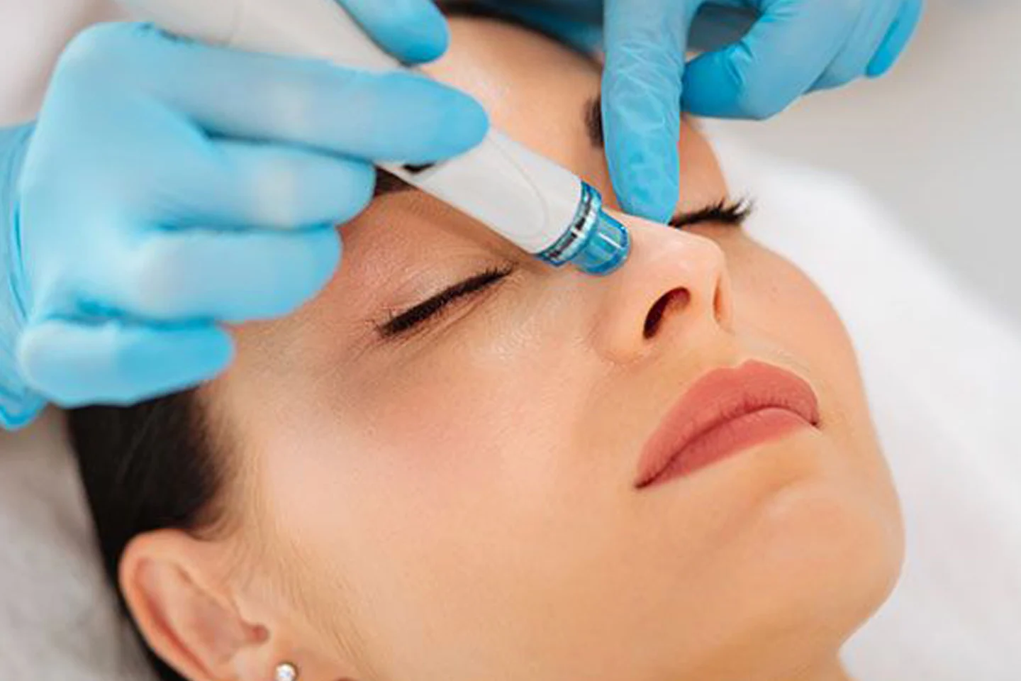 Hydrafacial in Mission Viejo, CA by MedGlo