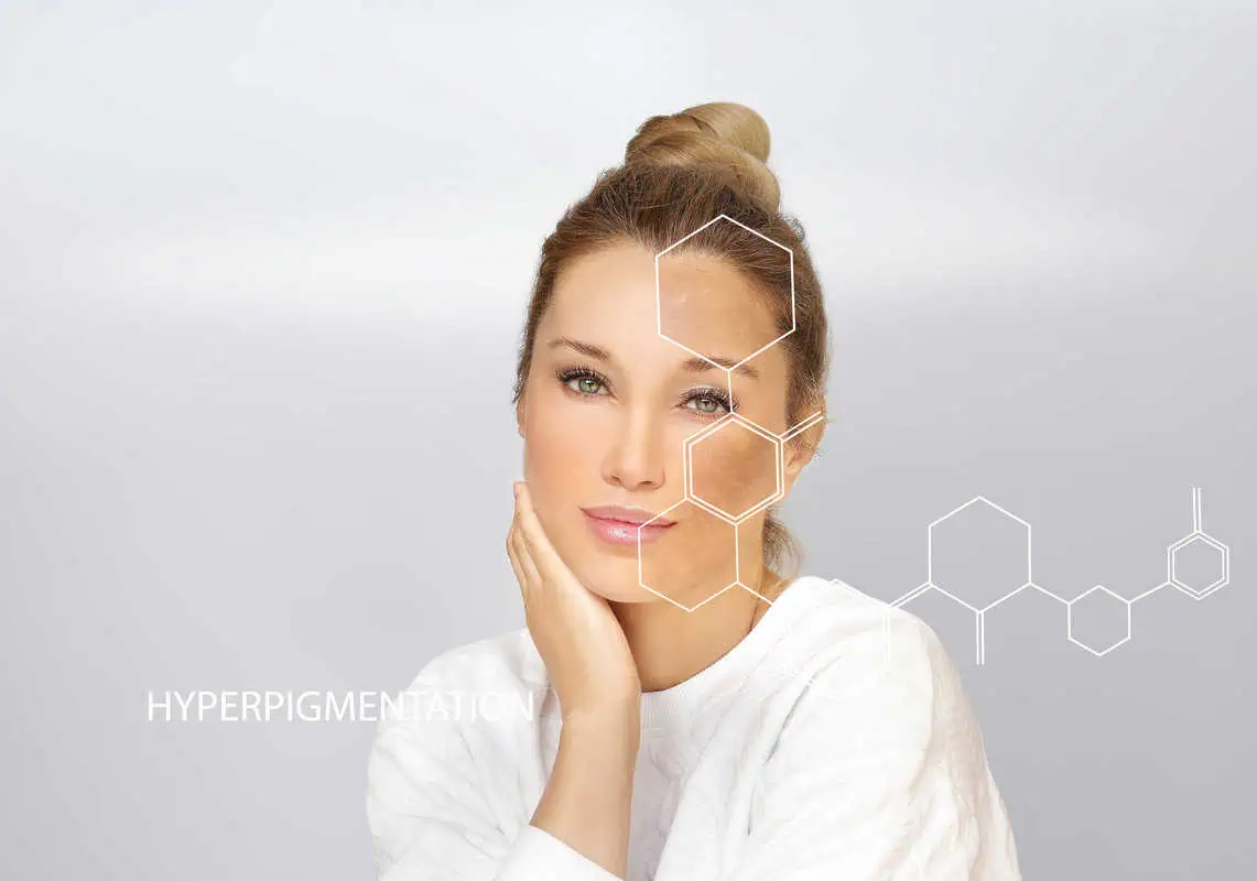 Hyperpigmentation by Medglo in Mission Viejo, CA